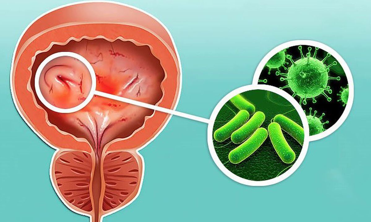 Come si sviluppa un'infezione alla vescica