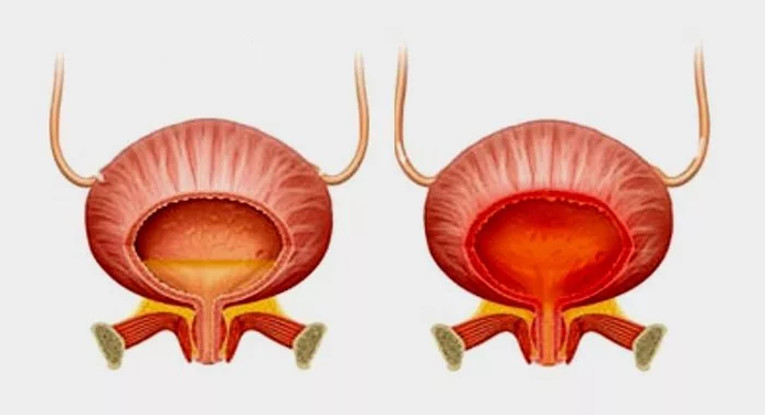 Vescica normale (a sinistra) e cistite con cistite (a destra)